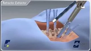 EVEREST® Minimally Invasive Surgical Technique Animation