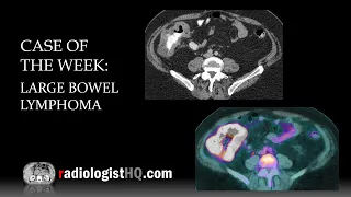 Case of the Week:  Large Bowel Lymphoma (CT & PET)