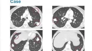 Pulmonary ArterioVenous Malformations