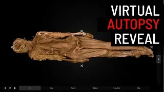 Virtual autopsy on 150-year-old remains shows how smallpox colonizes the human body