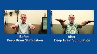 Parkinson's Disease Before and After Deep Brain Stimulation