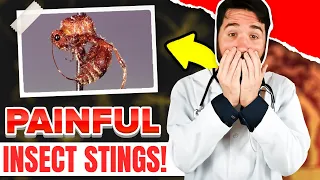 25 Most Painful Insect Stings In The World