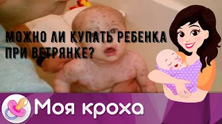 Можно ли купать ребенка при ветрянке?