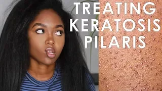 TREATING KERATOSIS PILARIS - 3 EASY STEPS