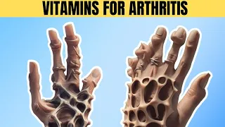 Top 7 Vitamins to Heal Arthritis!