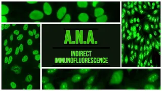 A.N.A. | Anti-nuclear Antibody | IIF | SLE | Sjogren | RA | CREST