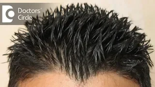 How to treat Androgenic Alopecia not responding to minoxidil & finasteride? - Dr. Aruna Prasad