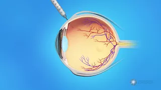 Eye Injections for Branch Retinal Vein Occlusion (BRVO)
