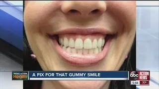 Botox injections in the upper lip area fixes "gummy" smiles