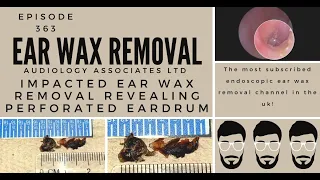 IMPACTED EAR WAX REMOVAL REVEALING PERFORATED EARDRUM   EP363