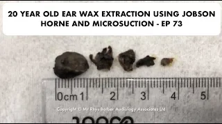 20 YEAR OLD EAR WAX REMOVAL USING JOBSON HORNE AND MICROSUCTION - EP 73