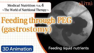 Medical Nutrition ~The World of Nutritional Therapy~ Vol.4  Feeding through PEG (gastrostomy)