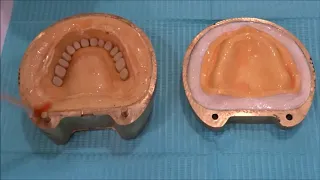 Processing of Complete dentures