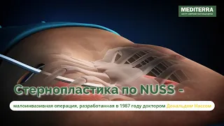 🔷 Операция Cтернопластика по Nuss