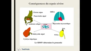 Choc Septique - Professeur Benmoussa