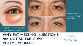 Why Fat Dissolving Injections are Not Advised for Treating Under Eye Bags