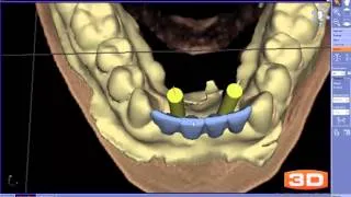 Implant Plan Review - Lower Anterior Implant Bridge