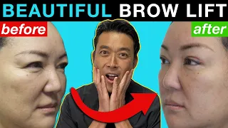Brow Lift Makes Her Look 20 Years Younger?!