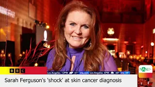 Sarah Ferguson,Duchess of York, diagnosed with malignant melanoma,an aggressive form of skin cancer,