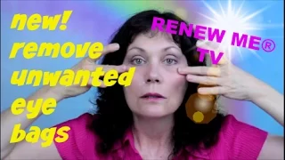 Remove Eye Bags | Under Eye Fluid | Festoons | Malar Bags Using Easy Exercise for Face | FACEROBICS®