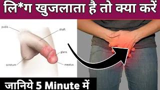 Balanitis treatment in Hindi | li**g जब खुजलाता है तो क्या करें