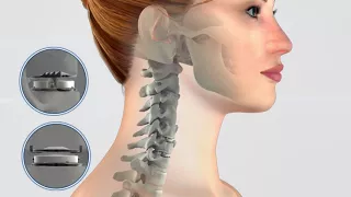 Cervical Disc Surgery - Mobi-C versus Fusion