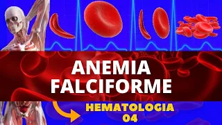 ANEMIA FALCIFORME (ANEMIA HEREDITÁRIA) - HEMATOLOGIA