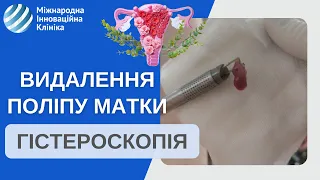 Видалення поліпу ендометрію (поліп матки). Відео через камеру гістероскопа #shorts #shortsvideo