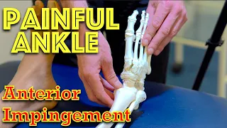 Ankle Pain - Anterior Impingement - Dr Gill