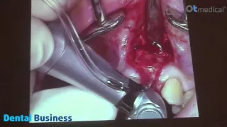 Видео-операция 1 “Установка имплантата OT-F1, OT Medical”, Доктор Хансйорг Хайдриг (Германия)
