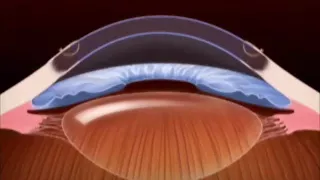 Cornea transplant