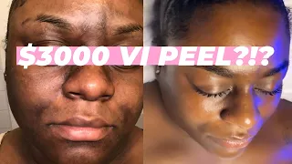 DRAMATIC VI Peel Before and After for Melasma