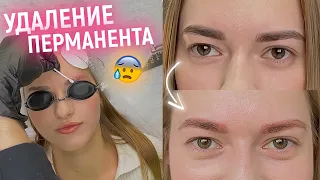 ❌НЕ ДЕЛАЙ ЛАЗЕРНОЕ УДАЛЕНИЕ ПЕРМАНЕНТА БРОВЕЙ пока не посмотришь это видео😱Результат от 2х процедур