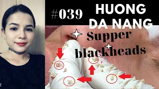 #039 | Supper blackheads | Mụn đầu đen lớn | Acne treatment Hương Đà Nẵng Official