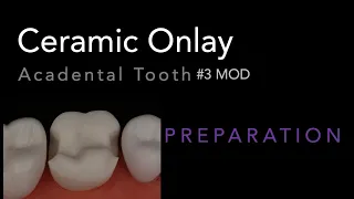 MOD Ceramic Onlay #3 Acadental | Dr. Richard Stevenson