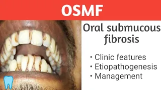 OSMF- oral submucosal fibrosis Clinical features, Etiology, Diagnosis, Management #easydent