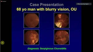 White Dot Syndrome: Fascinating and Frustrating Quan Dong Nguyen