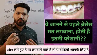 ब्रेसेस लगाने से पहले ये बात समझ ले Understand this before getting braces (ENGLISH SUBTITLE )