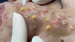 [NOSE] Relaxing with Sac Dep, WIN Spa, Loan Nguyen Official, Snake Tahunet Remove Blackhead