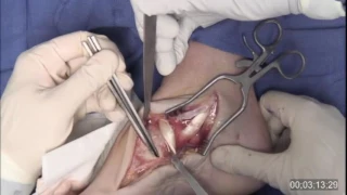 Flatfoot Osteotomies Using the Arthrex 6.7 mm Screws, Biosync Evans Wedge, and Biosync Cotton Wedge