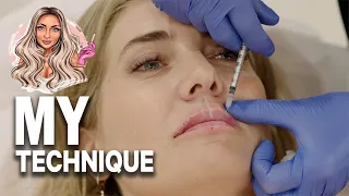 Watch this full treatment of RUSSIAN LIPS | Dermal filler - Before & after