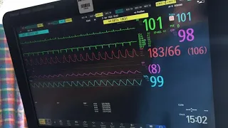 👇ICU monitor in Hospital👇#doctor#lifestyle