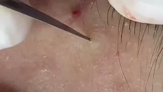 SAC DEP SPA Blackheads | #683