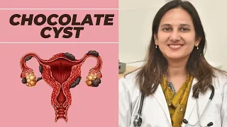 What Is Chocolate Cyst? | Chocolate Cyst (Ovarian Endometrioma) |  Cause | Symptoms | Treatment