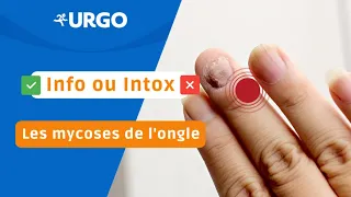 Info ou Intox : Les mycoses de l’ongle | URGO