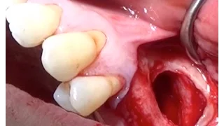 Maxillary Sinus lift-Surgical Video.