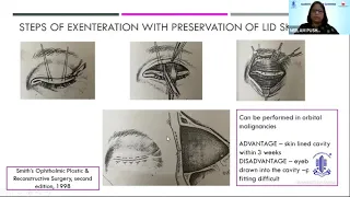 PG Update Series on  ORBIT & OCULAR ONCOLOGY - Dr. NEELAM PUSHKER