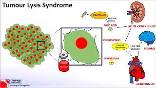 Tumour Lysis Syndrome