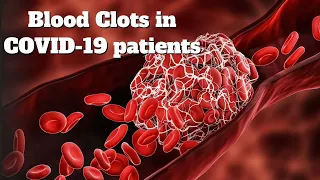 Irish scientists find the reason for blood clots in COVID-19 patients