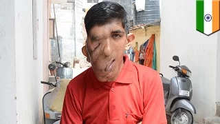 Indian teen scared to leave village after tumor makes his face look like it's melting - TomoNews